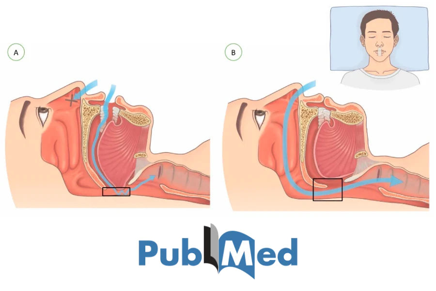 El impacto de la cinta bucal en respiradores bucales con apnea obstructiva del sueño leve: Un estudio de PubMed